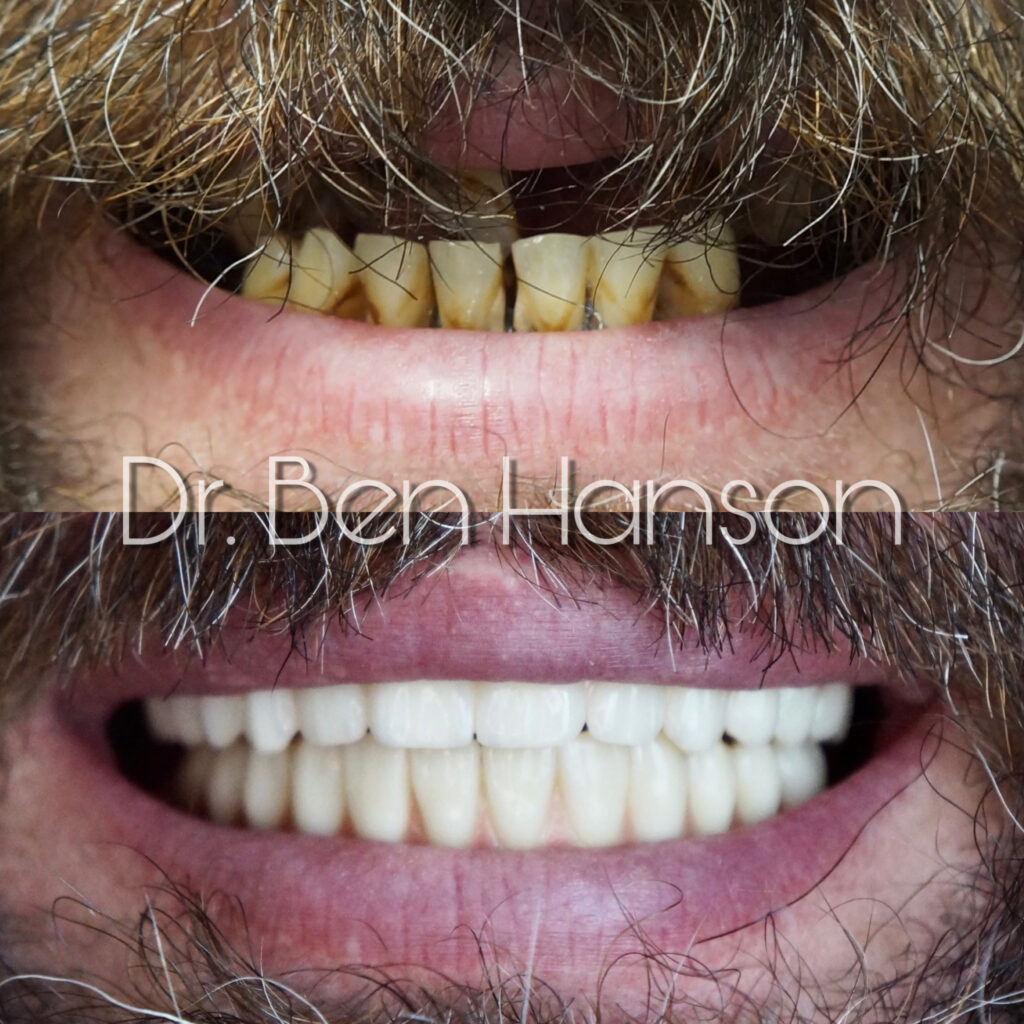 Before & After Dental Implant Treatment