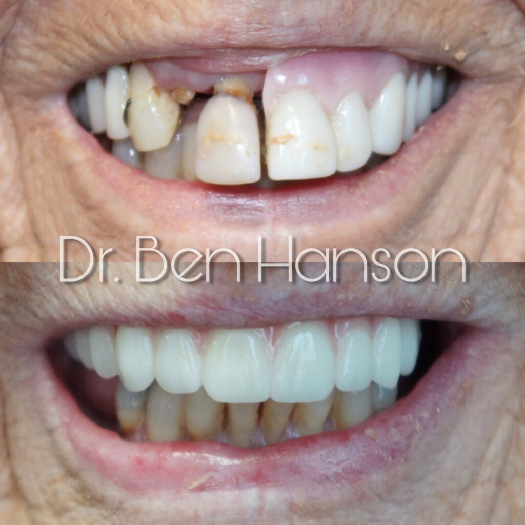 Before & After Dental Implant Treatment